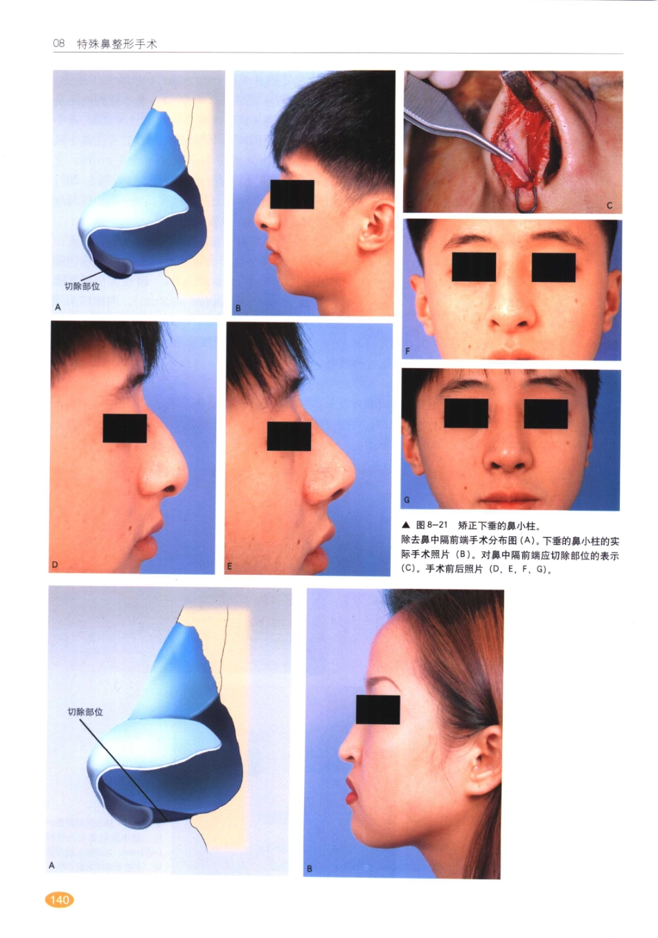 现代韩国鼻整形术_141-160.pdf_第1页