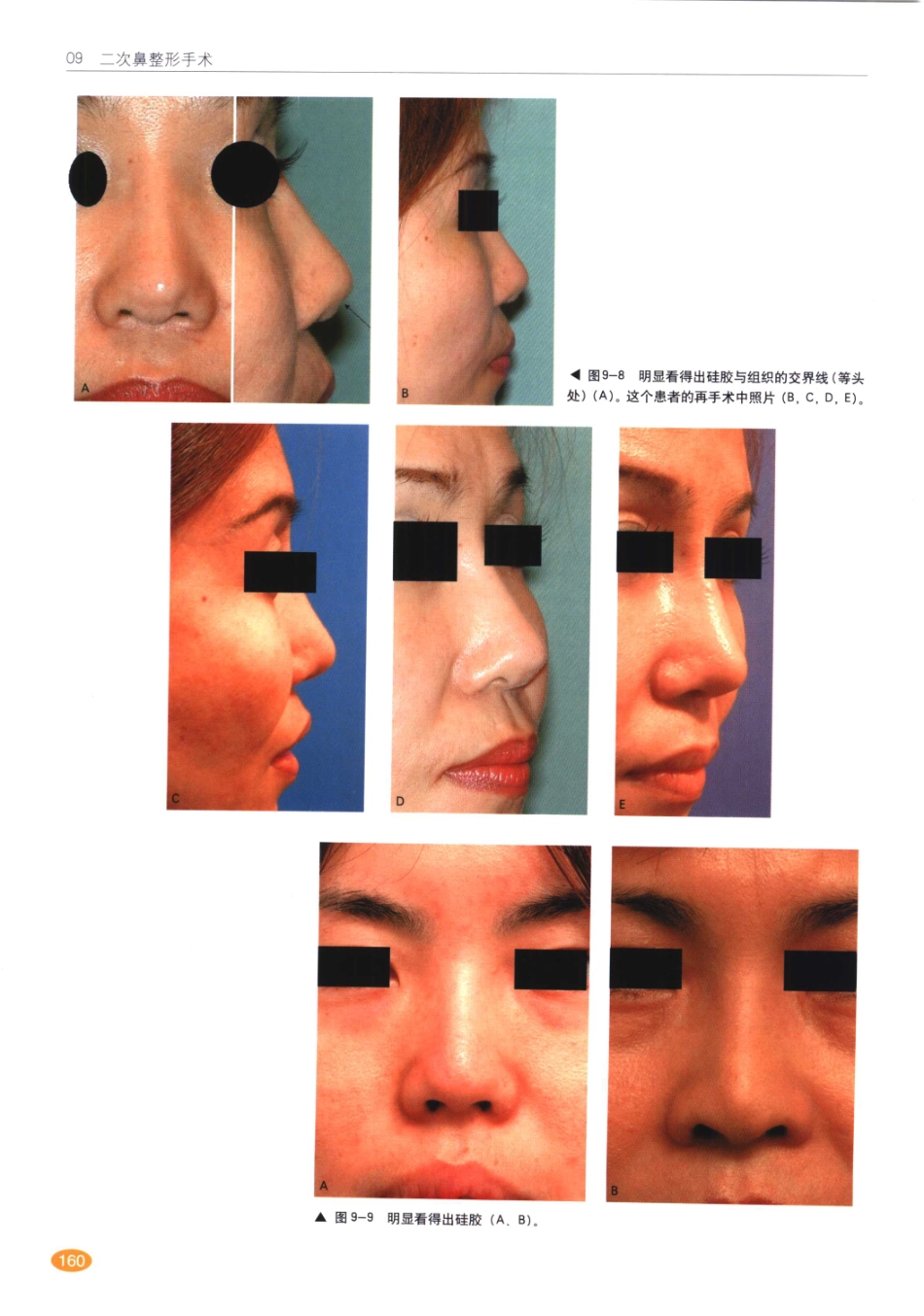 现代韩国鼻整形术_161-180.pdf_第1页