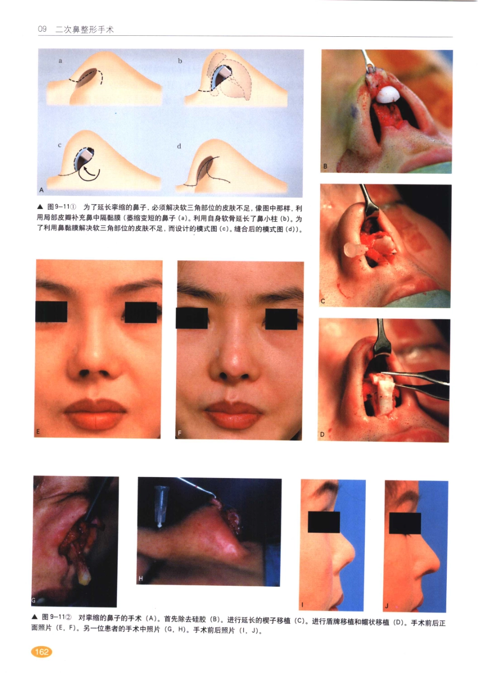 现代韩国鼻整形术_161-180.pdf_第3页