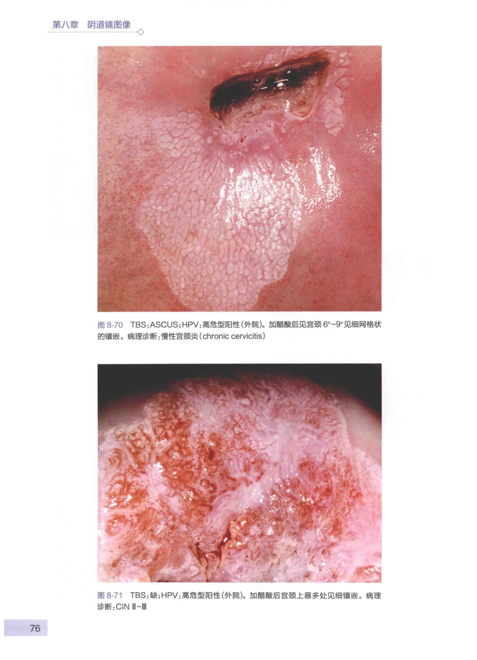 阴道镜图谱  第3版_14003389_91-135.pdf_第1页