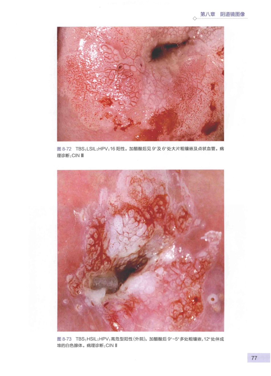 阴道镜图谱  第3版_14003389_91-135.pdf_第2页