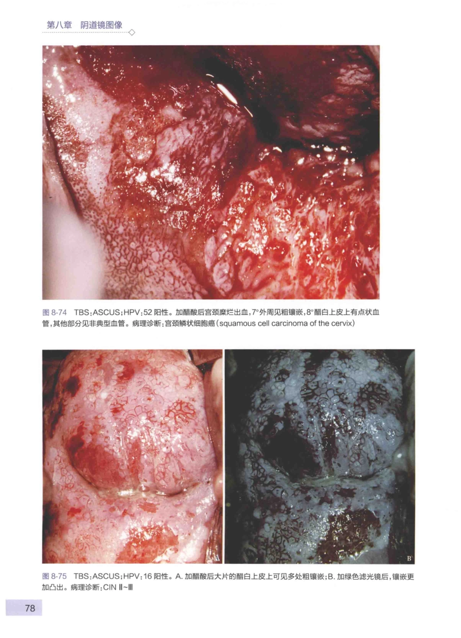 阴道镜图谱  第3版_14003389_91-135.pdf_第3页