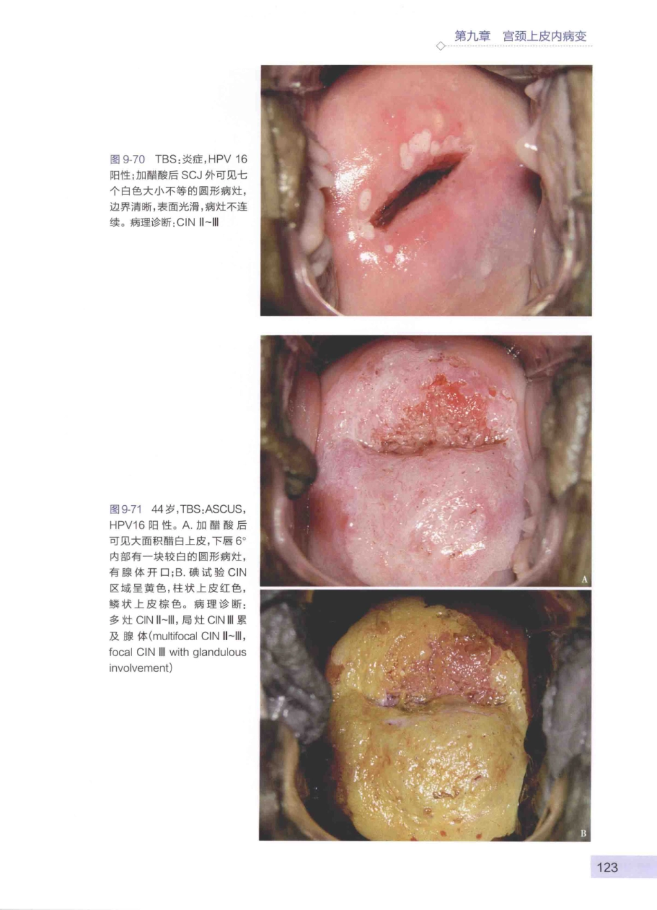 阴道镜图谱  第3版_14003389_136-180.pdf_第3页