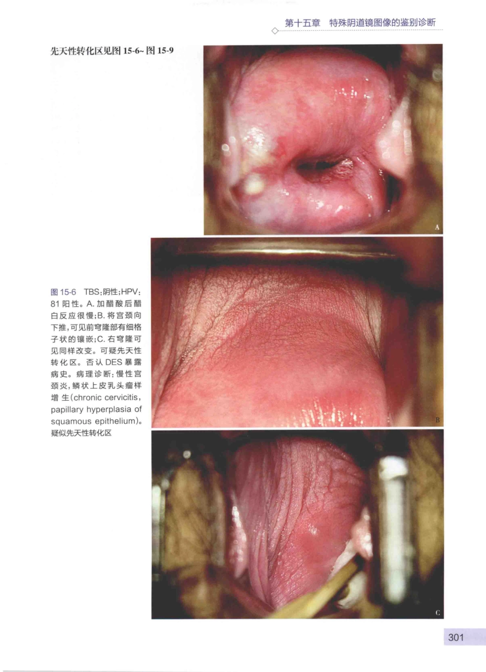 阴道镜图谱  第3版_14003389_316-360.pdf_第1页