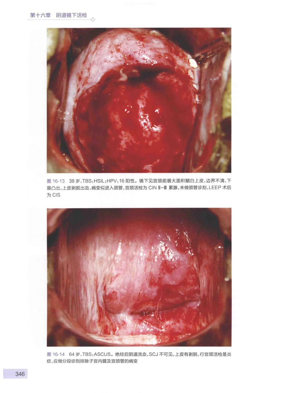 阴道镜图谱  第3版_14003389_361-405.pdf_第1页