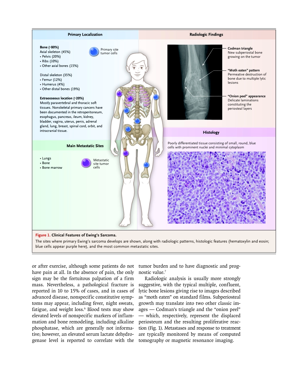 医学：尤文氏肉瘤 Ewing’s Sarcoma.pdf_第2页