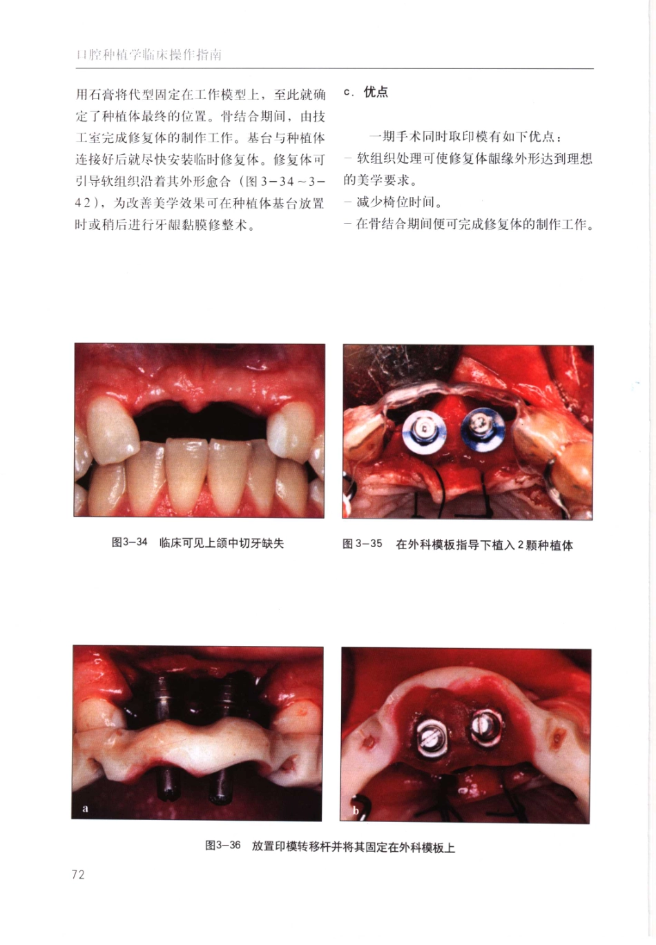 国际牙科名著系列-口腔种植学临床操作指南_严宁 译 _81-120.pdf_第1页