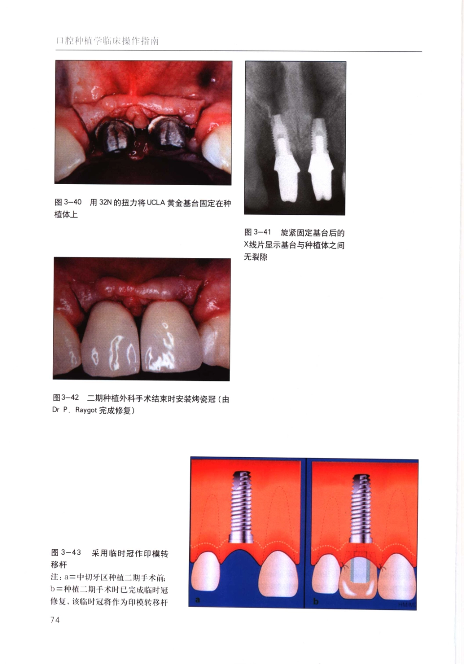 国际牙科名著系列-口腔种植学临床操作指南_严宁 译 _81-120.pdf_第3页