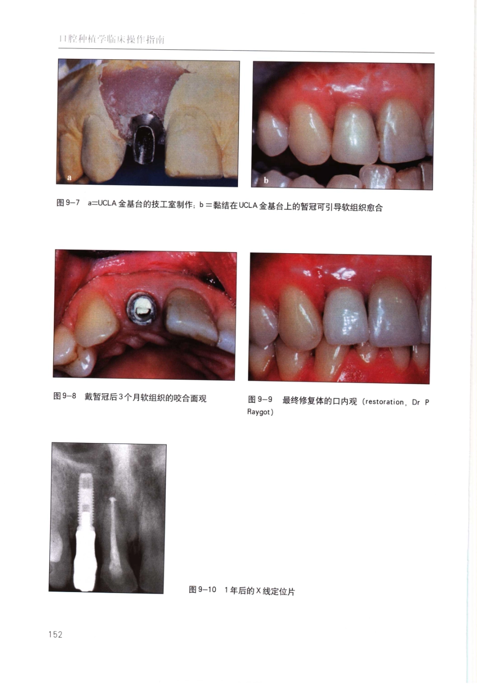国际牙科名著系列-口腔种植学临床操作指南_严宁 译 _161-200.pdf_第1页