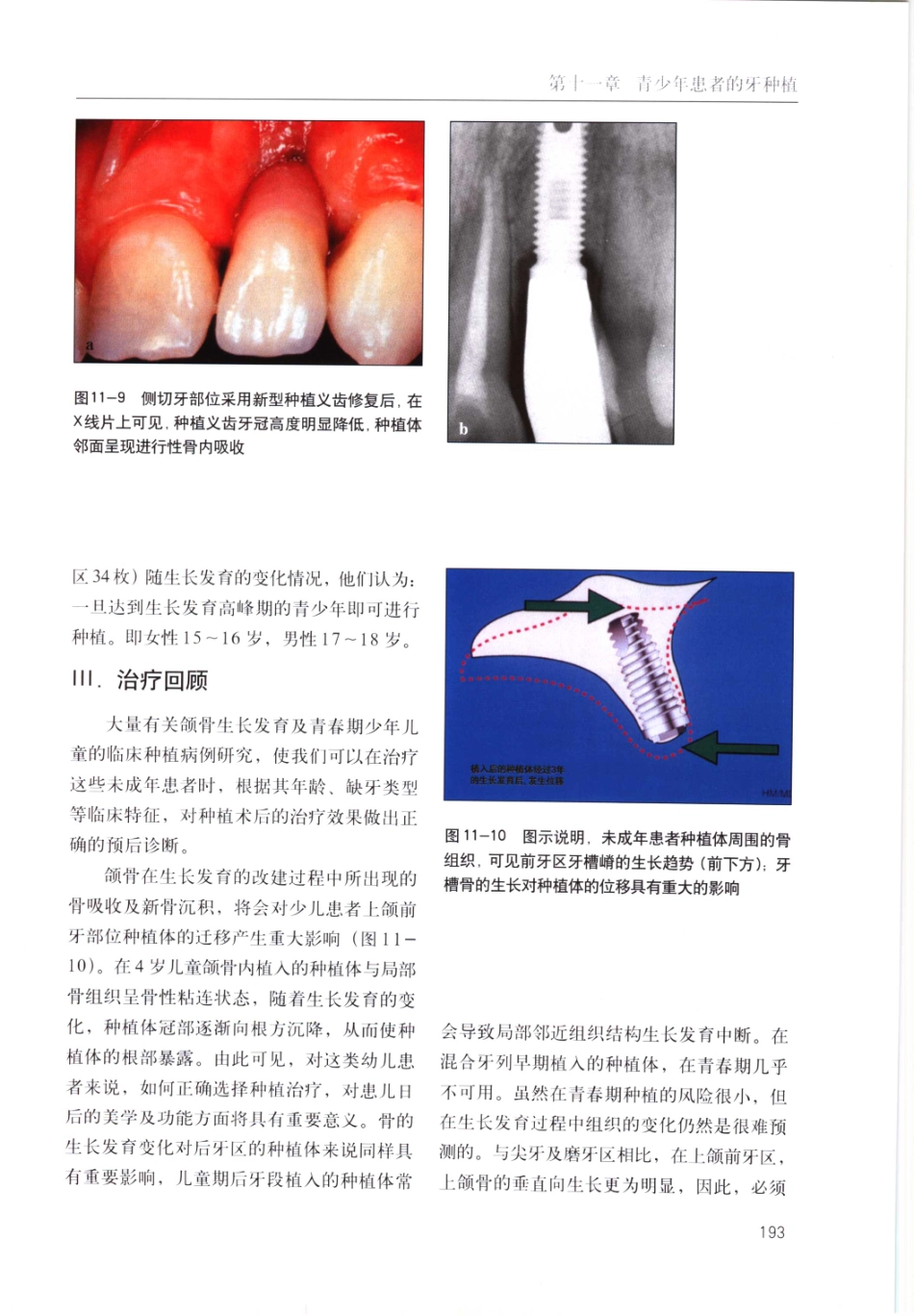 国际牙科名著系列-口腔种植学临床操作指南_严宁 译 _201-217.pdf_第2页