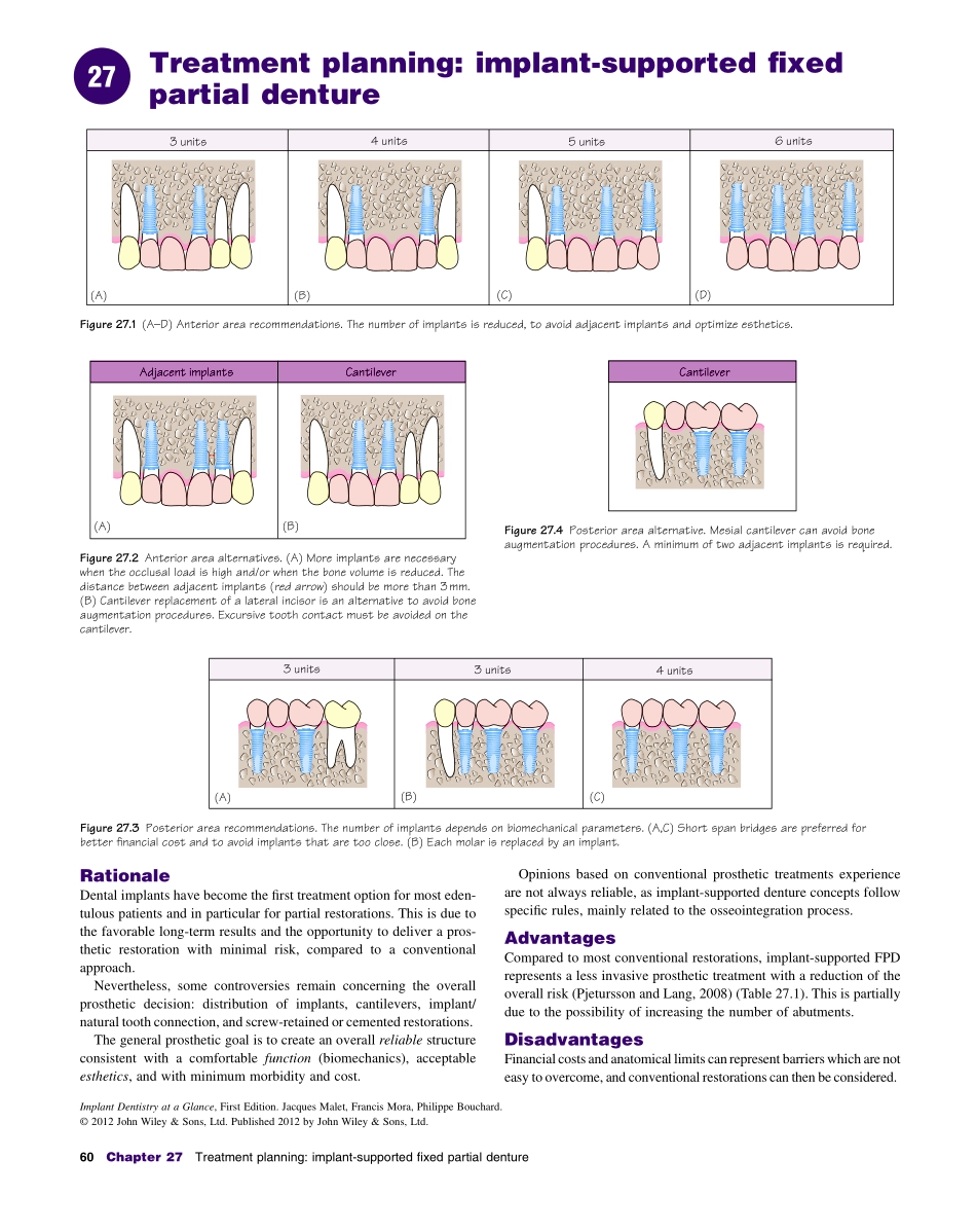 种植Implant Dentistry at a Glance（2012）_61-90.pdf_第2页