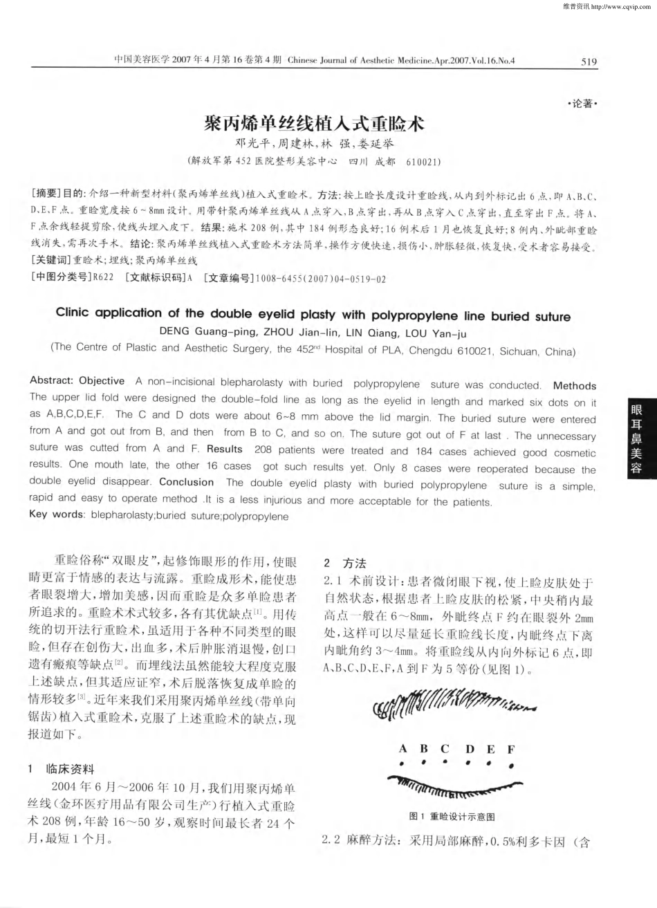 聚丙烯单丝线植入式重睑术.pdf_第1页