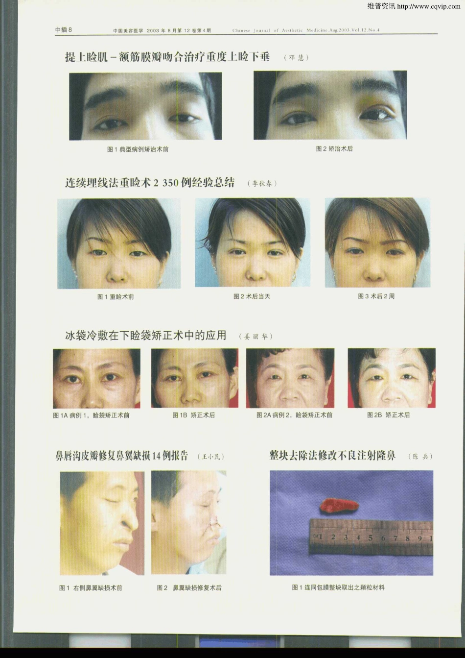 连续埋线法重睑术2350例经验总结.pdf_第3页
