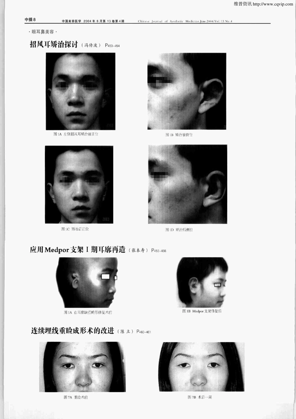 连续埋线重睑成形术的改进.pdf_第3页