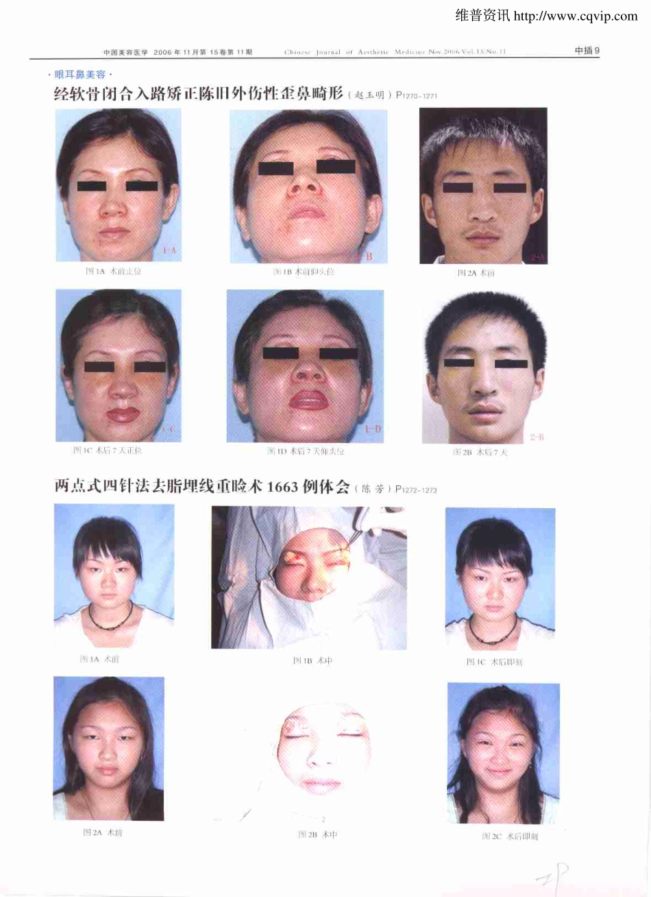 两点式四针法去脂埋线重睑术1663例体会.pdf_第3页