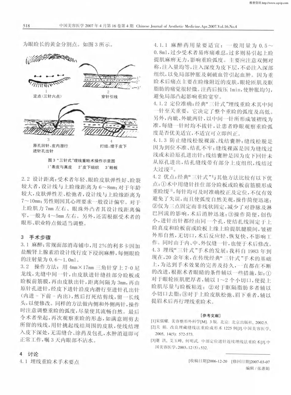 三针式埋线重睑术15万例经验总结.pdf_第2页