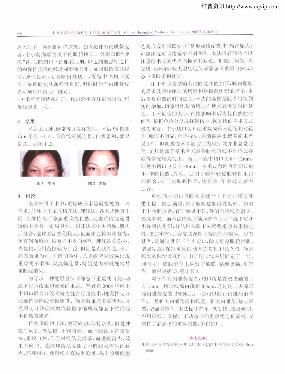 微创重睑术102例体会.pdf_第2页