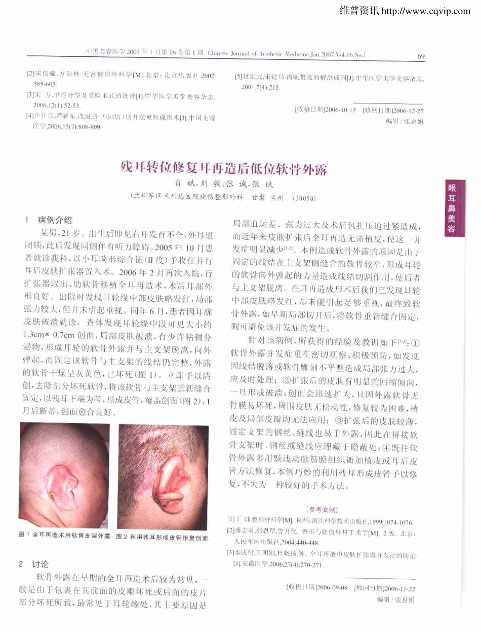 微创重睑术102例体会.pdf_第3页