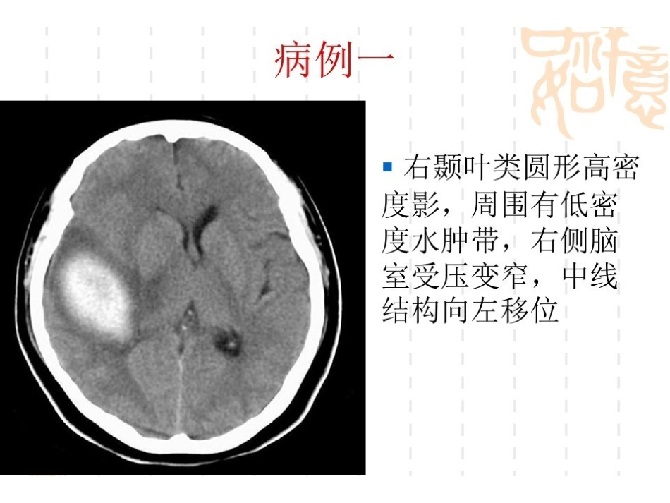 医学影像学病例讲解.pdf_第2页